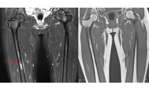 Avulsion des adducteurs (thigh splint) versus fracture de fatigue