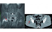 Résorption de dépôts d'hydroxyapatite dans l'aponévrose des muscles fessiers