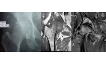 Coxarthrose destructrice rapide