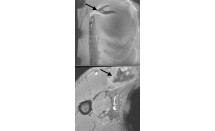 Séquelles de rupture de la jonction myotendineuse du grand pectoral