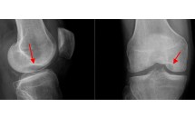 Ks - Fissure osseuse sous-chondrale du condyle fémorale interne