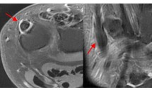 Tendinopathie de l'extenseur ulnaire du carpe