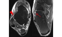 Rupture du ligament calcanéo-cuboïdien