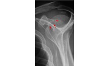 Fracture de la coracoïde