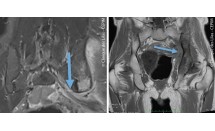 Métastase osseuse avec extension dans le canal sous-piriforme avec irritation du nerf sciatique