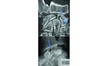 Rupture du ligament scapho-lunaire/« SLAC Wrist »