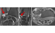 Lésion traumatique du ligament triangulaire du carpe