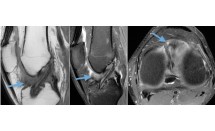 Arthrofibrose ou «cyclops»
