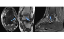 Fracture du processus latéral du talus