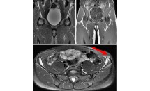 Apophysite et arrachement du noyau d'ossification de l'épine iliaque antéro-supérieure