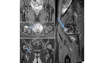 Fracture de fatique de la tête fémorale