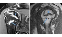 Ostéonécrose de la tête humérale secondaire à une fracture du col chirurgical