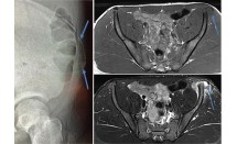 Désinsertion du noyau d'ossification de l'épine iliaque antéro-supérieure (EIAS)