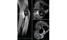 Compression de la branche motrice du nerf radial par une récidive postopératoire d'un kyste synovial de l'articulation huméro-radiale