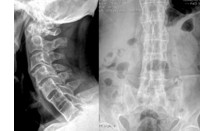 Spondylarthrite ankylosante