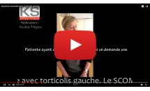 Dystonie cervicale avec torticolis gauche