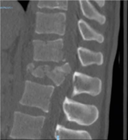 Utilisation sportive de l'exosquelette auto-équilibré ATALANTE® dans un cas de paraparésie secondaire à un syndrome de la queue de cheval post-traumatique