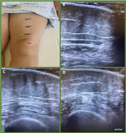 Évaluation de l'oedème : apport de l'échographie