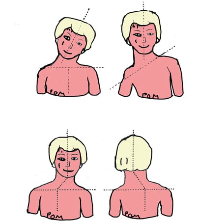 Technique d'étirement musculaire du SCM dans les torticolis myogéniques du nourrisson