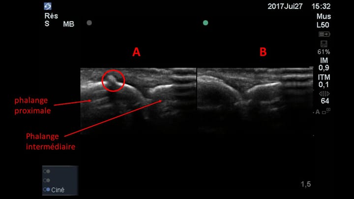 L'échographie : valeur diagnostique pour la détection d'une fracture osseuse