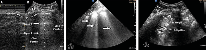 Monitoring de l'amélioration de l'aération pulmonaire par échographie après kinésithérapie respiratoire chez des patients sous ventilation mécanique