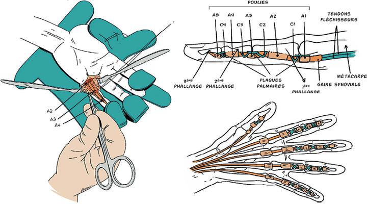 Remise en charge après suture directe des poulies A2 et A4 sur l'auriculaire à propos d'un cas clinique