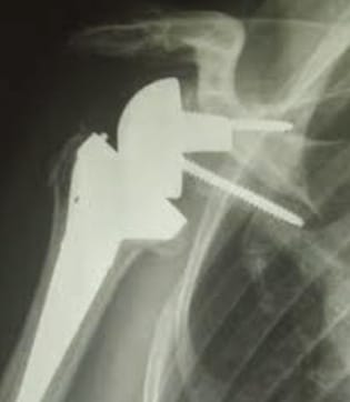 Prothèse inversée d'épaule