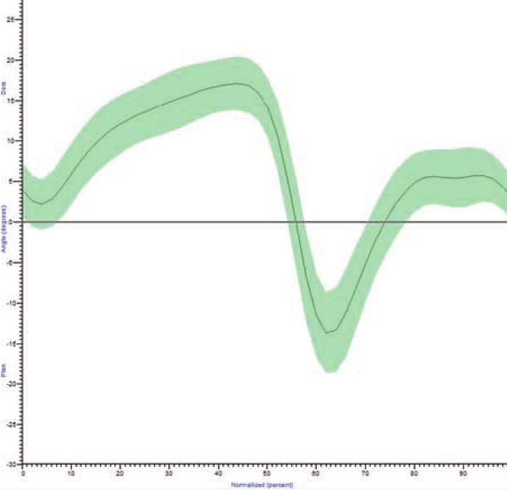 Le recurvatum de genou en phase d'appui chez le patient hémiplégique : analyse et proposition de traitement (1ère partie)