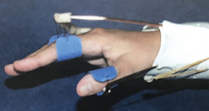 Bilan de la paralysie radiale