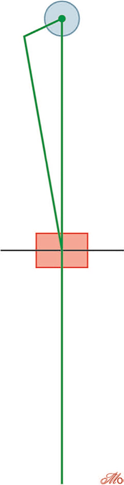 Réaliser une arthroplastie totale de genou est un compromis