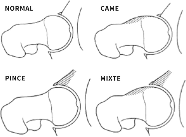 Le conflit de hanche : du diagnostic au traitement