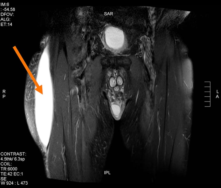 Cas clinique : masso-kinésithérapie dans le cadre d'un syndrome de Morel-Lavallée