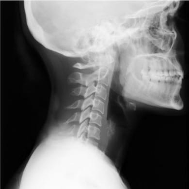 Un cas à part : la cervicalgie d'une chanteuse lyrique