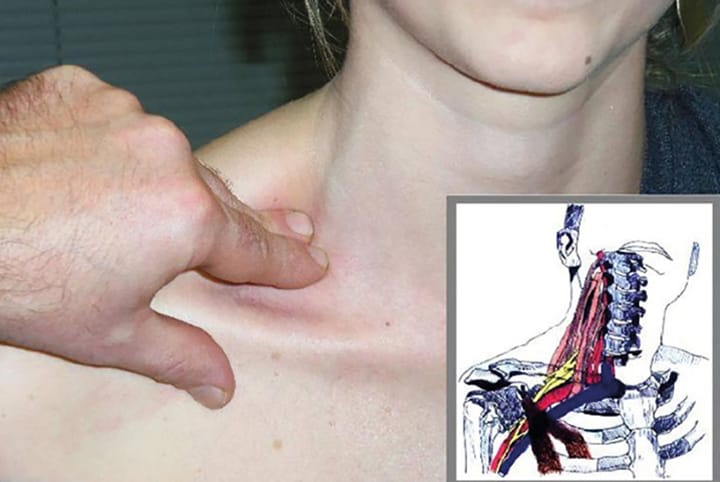 Mise au point sur le syndrome du défilé thoraco-brachial et le syndrome du plexus brachial : examen clinique spécifique (pour tous) et protocole de rééducation
