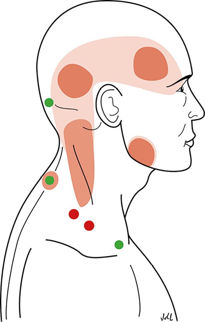 Dry needling du muscle trapèze supérieur en cas de cervicalgies et/ou de céphalées de tension basé sur la littérature scientifique récente