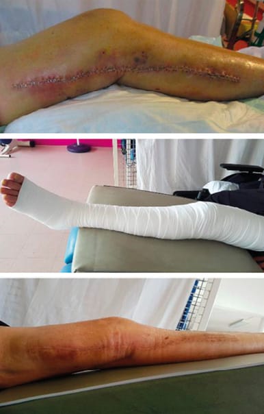 Prise en charge de l'oedème chez le patient amputé : revue de littérature et analyse des pratiques professionnelles