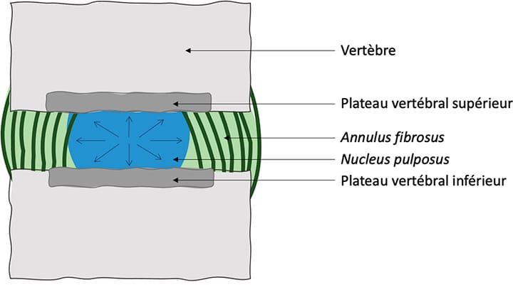 Approche mécaniste dans le traitement des discopathies dites dégénératives