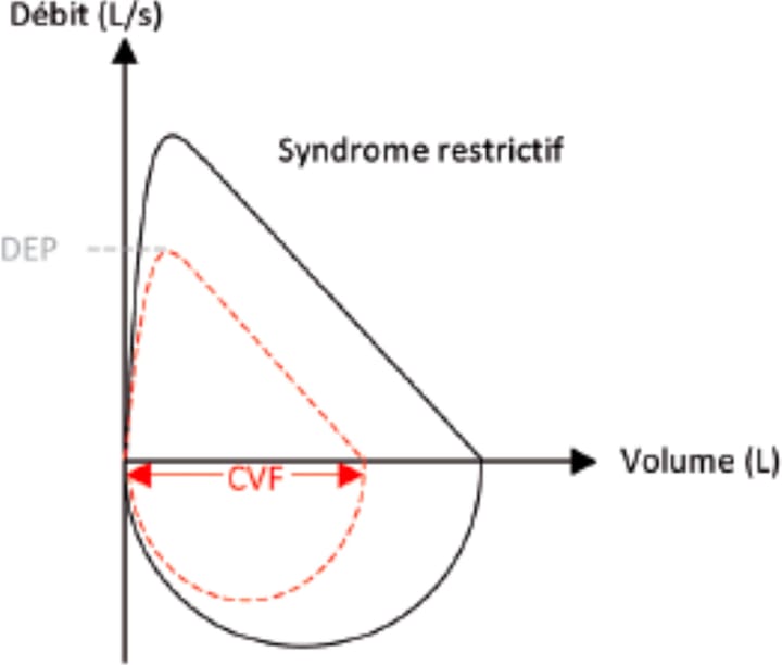 Intérêt de l'échographie musculaire respiratoire et périphérique dans l'évaluation de la tolérance à l'effort chez le sujet atteint d'obésité