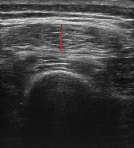 Intérêt de l'échographie musculaire dans la sarcopénie