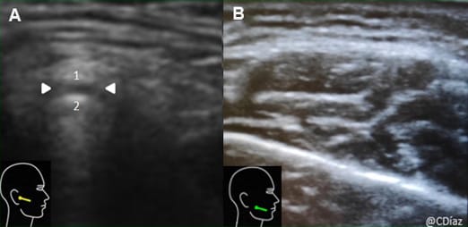 Échographie appliquée à la rééducation oro-maxillo-faciale : pourquoi tout kinésithérapeute maxillo-facial devrait avoir un échographe ?
