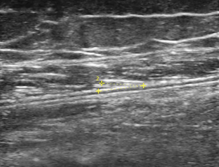 Échographie musculaire et évaluation du muscle squelettique dans l'obésité sarcopénique
