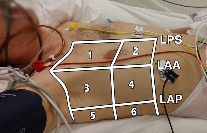 Apport de l'échographie pulmonaire dans le diagnostic et le suivi de la COVID-19