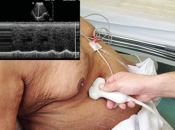 L'échographie du diaphragme : atouts et limites dans la prédiction du sevrage de la ventilation mécanique
