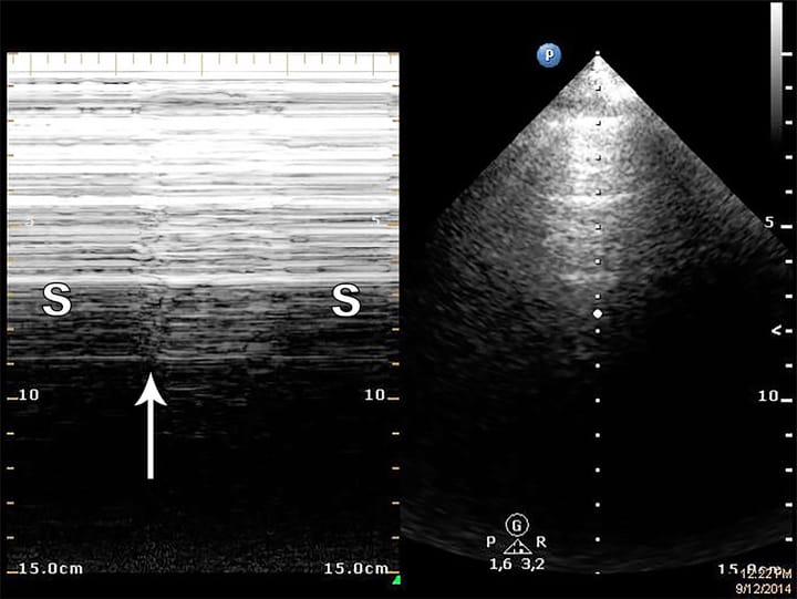 L'échographie pleurale : intérêt en kinésithérapie respiratoire