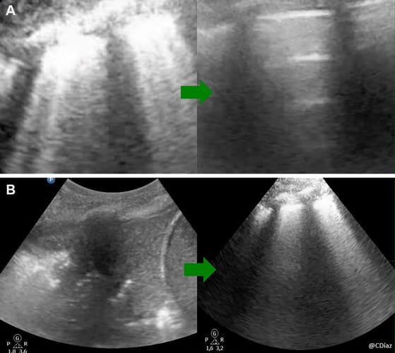 Échographie : un outil de choix tout au long du séjour en réanimation