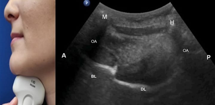 Échographie dans les troubles de la déglutition