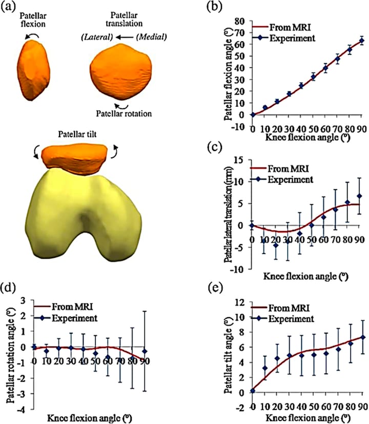 Quel profil «mécanique» dans le syndrome fémoro-patellaire ?