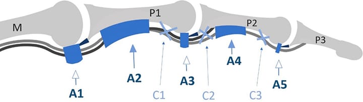 Rupture de poulie digitale : quel traitement aujourd'hui ?