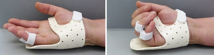 Rééducation après fracture de métacarpien des doigts longs : quel protocole aujourd'hui ?