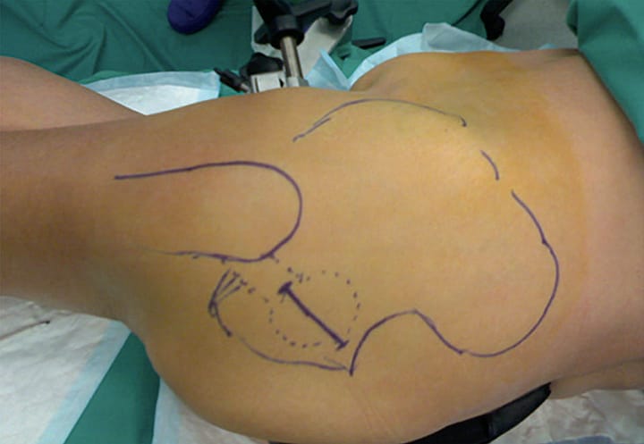 Et si on retournait aux fondamentaux ? Prothèse totale de hanche : évolution actuelle de la voie d'abord postérieure